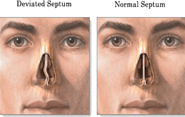 Difference between normal and deviated septum
