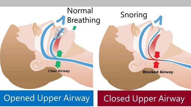 Two photos comparing airways with normal breathing vs snoring