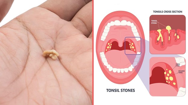 Picture of tonsil stones and where they come from in the mouth