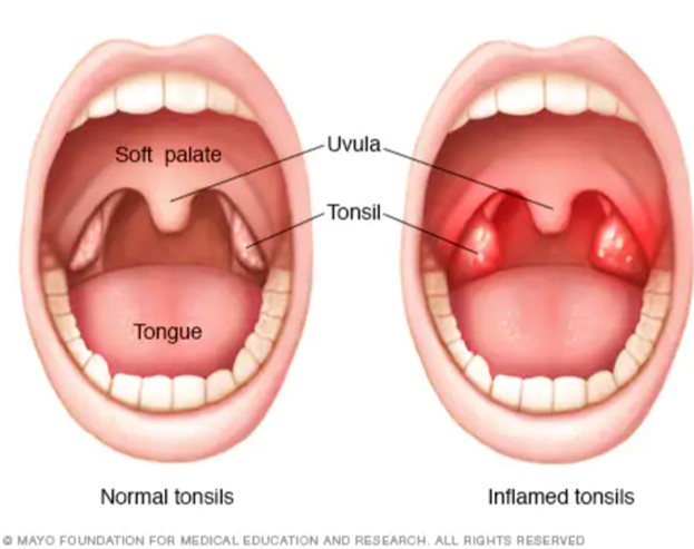 Image comparing normal and inflamed tonsilis